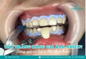 tẩy trắng răng giá bao nhiêu 1