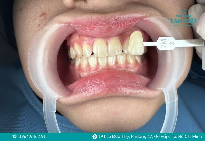 Tẩy trắng răng giá bao nhiêu? Bảng giá và lưu ý khi thực hiện 2 tẩy trắng răng giá bao nhiêu 2