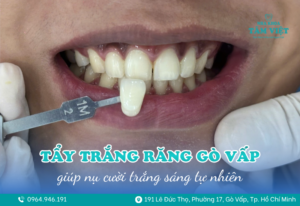 tẩy trắng răng gò vấp 1