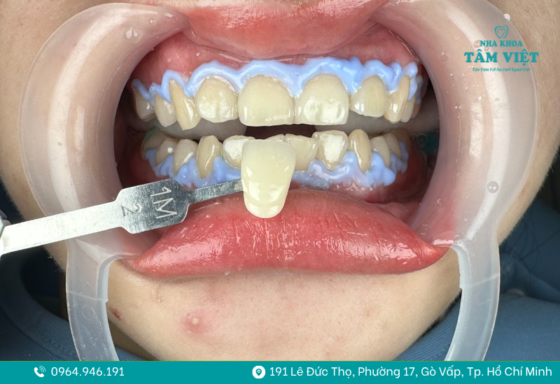 Tẩy trắng răng Gò Vấp giúp nụ cười trắng sáng tự nhiên 2 tẩy trắng răng Gò Vấp 2